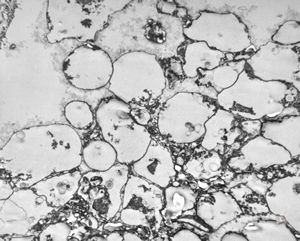 M,50y. | Pneumocystis carinii - lung